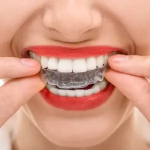 invisalign