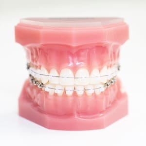 clear braces